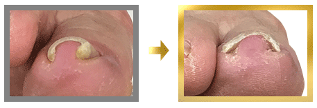 親指の爪の肉に食い込む巻き爪の状態