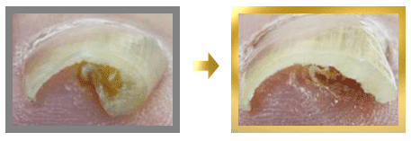 360度巻いた状態の巻き爪