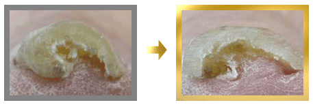 360度巻き込んだ巻き爪