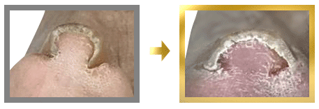 巻き爪が当たり前だと思っている