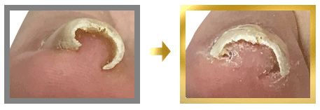 巻き爪を自分でケアしている