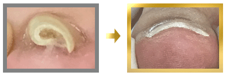 ワイヤーによる巻き爪補正3